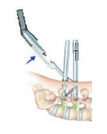 Операция транскутанной фиксации позвоночника (без разрезов)