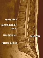 Варианты дегенеративных изменений межпозвонковых дисков