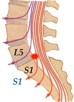 Грыжа диска L5-S1