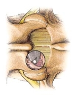Microdiscectomy procedure