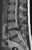 Spine surgery, part 1 - First steps