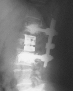 Transpedicular fixation with cannulated screws combined with vertebroplasty